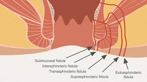 fistulas what you need to know about a