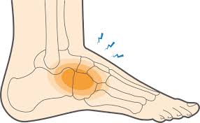 what is a midfoot sprain how to