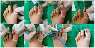 ingrown toenails