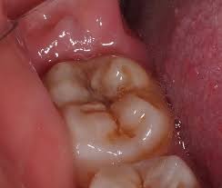 get rid of wisdom tooth pain case