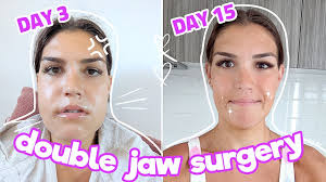 my double jaw surgery experience 2