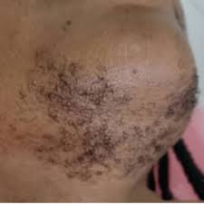what causes chin hair in women monitor