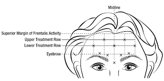 Printable Botox Face Chart Www Bedowntowndaytona Com