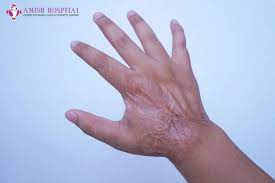 can severe burn scars be removed with