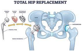 a new minimally invasive hip