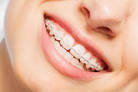 Understanding the Different Types of Braces to Enhance Your Smile: Le  Dentistry & Associates: Dentists