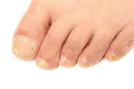 understanding fungal nail infections