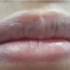 allergic contact cheilitis due to lipstick