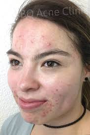 albuquerque skin care acne clinic