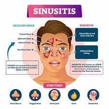 6 common symptoms of chronic sinusitis