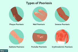 Psoriasis is often a lifelong condition. Psoriasis Overview And More