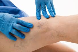 what to do about varicose veins