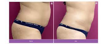 5 things you need to know about laser lipo