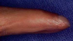 nail bed injury hand orthobullets