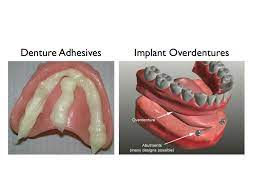 dental implants denture adhesives