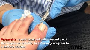 infected ingrown toenail