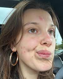 millie bobby brown shows her acne in no