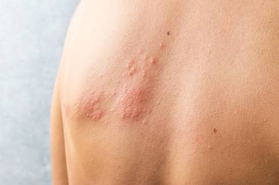 Celiac Disease and Dermatitis Herpetiformis (DH) | Health Answers by Pfizer