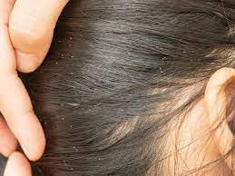 remove nits from hair naturally tips to