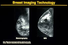 Breast ultrasounds and breast mris give your doctor different and sometimes more detailed views otherwise, your doctor will likely do a sentinel node biopsy and remove nearby lymph nodes when find the right cancer center, oncologist, and surgeon for you. Mammogram Images Normal And Abnormal