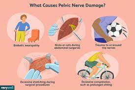 what causes pelvic nerve pain