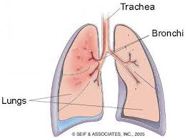Image result for bronchitis