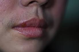 herpes virus infection on woman mouth