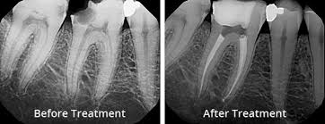 Dicoloration is because of the dead pulp in the tooth. Root Canal Treatment Essex Endodontics Perfect Smile Spa