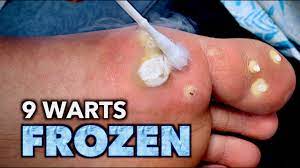 9 warts frozen on 1 foot with liquid