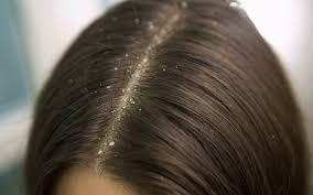 علاج قشرة الشعر الفطرية وظائف
