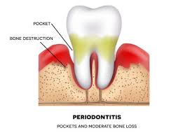 Can bone loss in teeth be reversed naturally? Gum Disease Treatment South Kensington At The Dental Team Periodontics