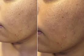 open pores on oily skin by shahnaz husain