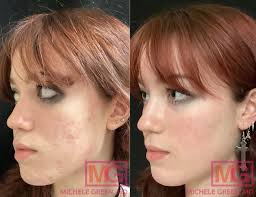accutane for acne treatment dr