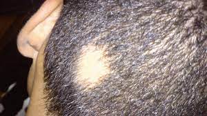 Hair loss is often of they look for rashes that may be associated with certain types of alopecia and for signs of virilization in women such as a deepened voice, hirsutism. Scalp Conditions Pictures Causes And Treatments