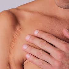 surgical scars treatment vancouver wa