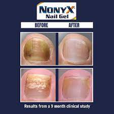 nonyx fungal nail clarifying gel 4 oz