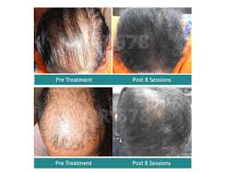 Discover & compare the best options for your search. Best Latest Hair Loss Treatment For Men And Women In India 2021