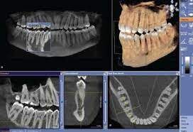 dental cone beam