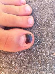 black toenails causes treatment