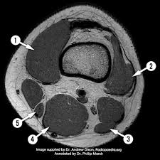 Click on the links to show each structure. Mri Knee Axial Anatomy Quiz Radiology Case Radiopaedia Org