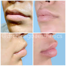 lip fillers before and after photos