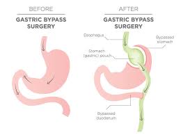 gastric byp benefits side effects