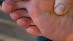 plantar warts from growing back