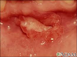 mouth ulcers information mount sinai