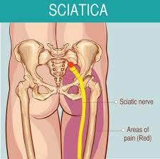 Pain typically occurs in the lower back, side, and groin. Why Do You Get Leg Pain When You Sit Or Drive Solutions Pt