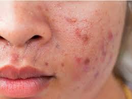 acne around your mouth
