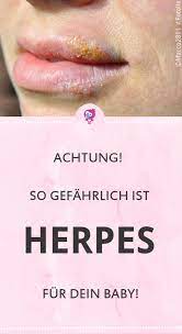 herpes für dein baby