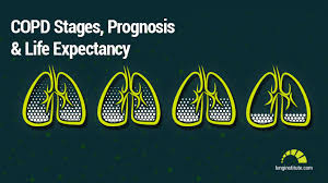 Copd Life Expectancy Stages And Prognosis Here Are Your Numbers
