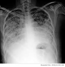 Pulmonary fibrosis causes a dry cough. Manifestaciones Pulmonares En Lupus Eritematoso Sistemico Afeccion Pleural Neumonitis Aguda Enfermedad Intersticial Cronica Y Hemorragia Alveolar Difusa Reumatologia Clinica