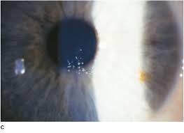 You are here the epithelium can have cloudy areas that resemble continents on a map, as well as opaque dots. Corneal Dystrophies Ento Key
